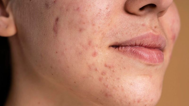 Miracle Acne Cure