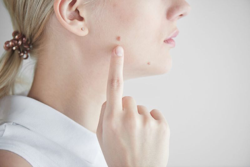Cure for Warts and Skin Tags