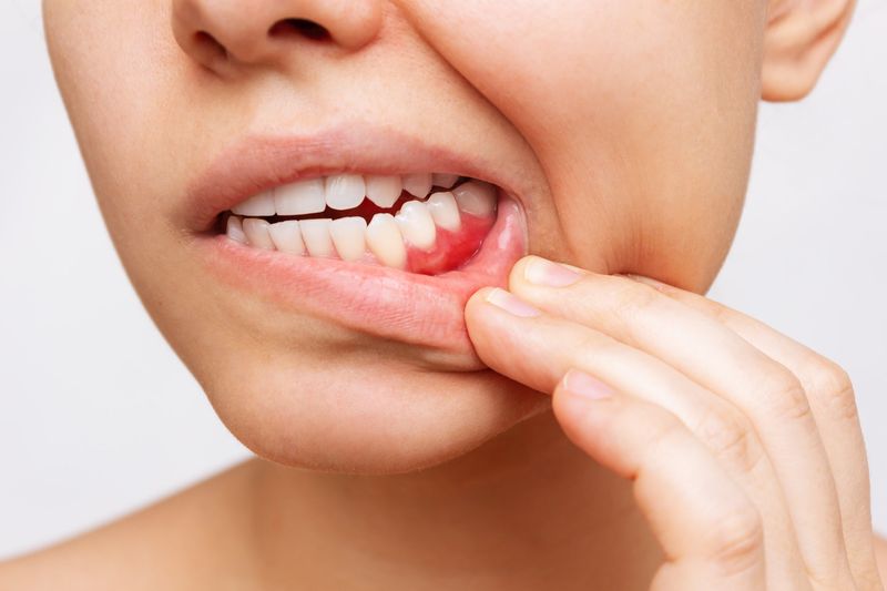 Relief from Gum Inflammation